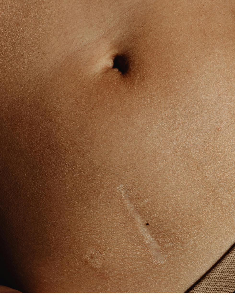 Close detail of skin on the stomach showing a healed scar
